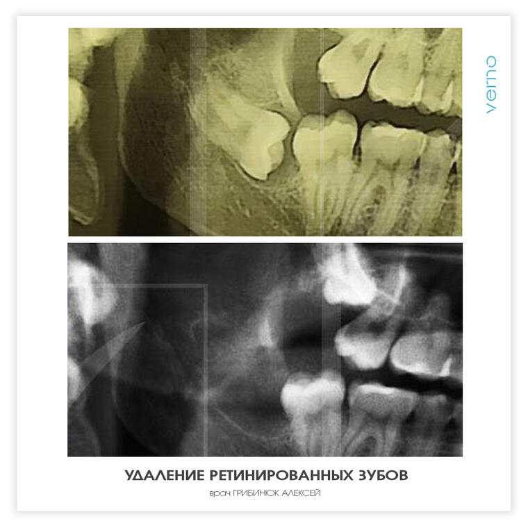 foto Видалення ретінірованних зубів
