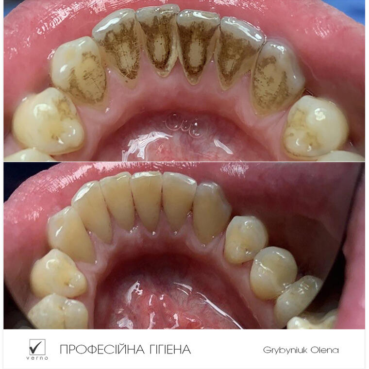 foto Професійна гігієна
