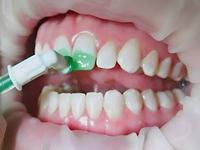  Treatment and filling of teeth