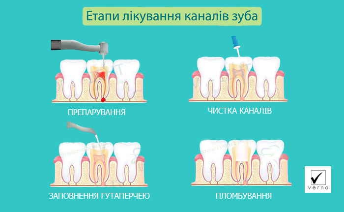 Лікування каналів зубів