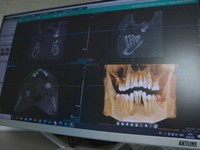  All about dental implants