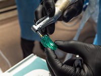  All about dental implants
